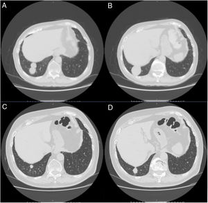 (Panels A and B) CT scan images showing the resolution of the ground-glass and reticular opacities after amiodarone withdrawal and the onset of two large nodules of 25mm and 11mm, respectively, which ensued in the right costophrenic sulcus. (Panels C and D) Follow-up CT images showing a substantial reduction in size of the right costophrenic nodules 18 months after amiodarone withdrawal.