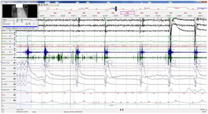 Baseline polysomnography: This figure evidences nocturnal characteristic bradypnea without effort in the chest/abdomen or oxygen desaturation. Associated electroencephalographic (EEG) arousals during stage REM. EEG channels (from top to bottom): C4/A1, C3/A2, O2/A1, EOG1/A1, EOG2/A1, ECG, EMG, snore, flow, thermistor, chest band, abdominal band, sum of band readings, phase angle, oxygen saturation, heart rate and position.