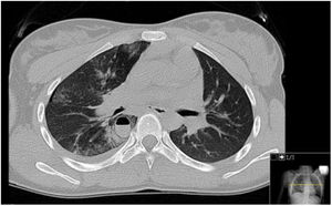 Thoracic CT demonstrating a cavitary lesion (70×28mm2) in the lower lobe of the right lung with air-fluid level and several diffuse alveolar consolidations.