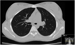 Thoracic CT performed 3 months later demonstrating complete resolution of the pulmonary lesions.