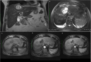 Abdominal MRI (A) Coronal plan, T2 HASTE sequences – nodular lesion in the IV/VIII segments of the liver (B) Axial plan, T2 FS weighted sequences – hypersignal with fluid and internal septae (C) before gadolinium injection (non-enhancement phase) (D) after gadolinium injection, arterial phase – without contrast enhancement (E) after gadolinium injection, portal phase- peripheral contrast enhancement of the lesion.