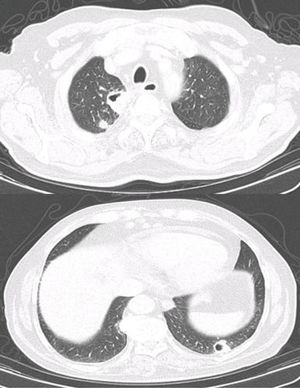Thoracic CT scan – axial plan – multiple peripheral nodules of both lungs, the bigger ones, cavitated.