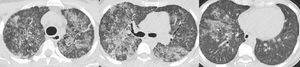 “Pulmonary alveolar proteinosis – imaging. Chest CT showing diffuse ground-glass areas with juxtaposition of healthy zones and thickening of the interlobular septa — crazy-paving”.
