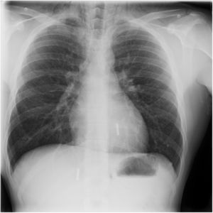 Chest radiography with evidence of pneumomediastinum.