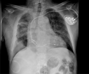 Chest radiograph of case 1 showing right pleural thickening with TIPC in situ.