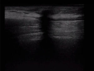 Ultrasound image of the local area showing a hypoechogenic spot in the medial tract of the previous tunnelling extending from the subcutaneous tissue down due to the acoustic shadow from the retained plug in the subcutaneous space.