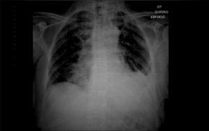 Chest radiograph of case 2 showing left pleural thickening with TIPC in situ.