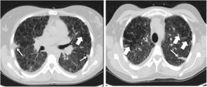 Pre-transplant computed tomography of the chest in lung window showing a diffuse change in the pulmonary architecture with multiples cists, some of them confluent with thin walls (large arrows) in relation with Langerhans cell histiocytosis. It is also described a septal thickening due to confluence of fibrotic areas with formation of some nodules (thin arrow).