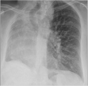 Thoracic X-ray: contracted hyperlucent hemithorax.