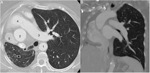 (A and B) CT scan. (1) Descendent aorta; (2) ascendent aorta; (3) left pulmonar artery; (4) pulmonary trunk; (5) superior vena cava.