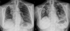 A. Postero anterior chest radiograph shows air space consolidation of rigth upper lobule with lung volume decrease (radiotherapy fibrosis). B. Postero anterior chest radiograph shows new heterogeneous bilateral air space opacities.