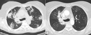 A. CT scan (lung window) shows multiple peripheral poorly defined areas of focal consolidation, very suggestive or organizing penumonia. B. CT scan (lung window), three month later shows resolution of peripheral areas of focal consolidation, but persistence of parahilar consolidation because of radiation fibrosis. Note the bronchiectasis and volume loss and the sharp demarcation between normal lung tissue and areas of fibrosis.