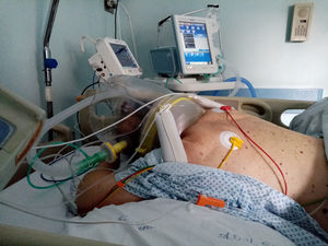 The figure shows a patient in prone position receiving hCPAP. One small pillow is positioned under the chest and another one under the head, to raise the head and to leave some free space around the neck.