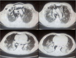 Bilateral pneumothorax, extensive PNM with subcutaneous emphysema and bilateral consolidations, ground-glass attenuation areas.