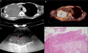 a) An approximately 15 × 10-cm mass in the right lung in thoracic CT. b) Heterogeneous FDG uptake with observed necrotic areas inside the mass in PET-CT. c) Anechoic necrotic foci in the ultrasonographic image of the same mass. d) Necrotic tissue specimen (HEx200) whose structural and cellular details cannot be evaluated in the histopathologic preparation.