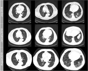 Follow-up chest CT scan axial images showing progressive, unspecific peripheral intralobular reticulation in the lower lung lobes. The time when the scans were performed is indicated on the left of each row of images. For comparative purposes, the images in each column correspond to identical axial planes.