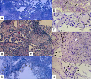 TBLC histopathology findings in HPAF. There are expressive peribronchiolar and subpleural changes, typical of HP and CTDs, respectively. (A) A prominent, dense interstitial chronic inflammatory infiltrate without lymphoid follicles with a predominantly bronchiolocentric distribution is seen. There are extensive lesions of peribronchiolar metaplasia (white - - - - -) and loose aggregates of epithelioid histiocytes – epithelioid granulomas (white *). A centrilobular region is marked with white # – hematoxylin and eosin (H&E) staining, 40× magnification. (B) Detail of a lesion of peribronchiolar metaplasia (white - - - - -), adjacent to the centrilobular region (white #) – H&E staining, 200× magnification. (C) Detail of an epithelioid granuloma (white *) – H&E staining, 200× magnification. (D) A moderate cellular chronic inflammatory infiltrate, extensively involving subpleural areas (), as well as alveolar septa, is also seen – H&E staining, 40× magnification. (E) Detail of organizing pneumonia lesion (→) – H&E staining, 200× magnification. (F) Detail of a multinucleated giant cell (▷ and •••••••) adjacent to the visceral pleura () – H&E staining, 400× magnification. (G) Detail of a pleura-centered epithelioid granuloma (white *) and focal mesothelial reactivity (►) interspersed with normal pleural mesothelium () – H&E staining, 200× magnification.