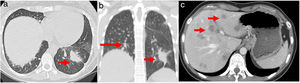 (a) Chest axial CT; (b) non-contrasting coronal CT shows left lower lung mass (arrow) and multiple small diffuse round nodules (long arrow) at diagnosis; (c) contrast axial abdominal CT shows multiple hypo-enhanced solid liver nodules according to diffuse liver metastases (arrows) following hepatic progression.