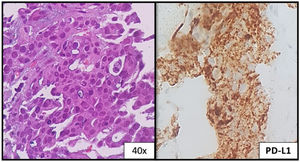 Liver: metastatic lung adenocarcinoma; the tumor cells show >50% PD-L1 expression.