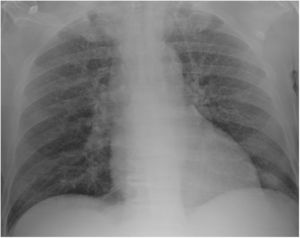 Chest radiograph on admission showing a diffuse opacities and nodules.