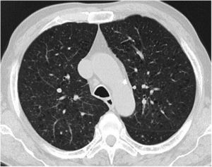 Thoracic CT scan showing pulmonary nodules in a miliary pattern.