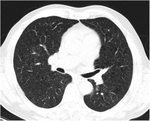 The high-resolution CT scan of thorax performed 6 months after discharge showed a marked reduction in the number and size of bilateral pulmonary nodules.