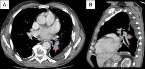Contrast-enhanced chest CT scan images (A: axial image; B:sagittal image) showing the anatomical relationships between the interlobar branch of the left pulmonary artery (outlined by blue dots), the 11 L lymph node station (outlined by red dashed lines) and the left lower lobe bronchus. Note that, in this patient, the 11 L lymph node station does not have direct contact with the bronchial wall.