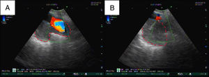 EBUS-TBNA color Doppler ultrasound images of the transvascular puncture of the 11 L lymph node station: the left pulmonary artery branch is outlined by blue dots and the 11 L lymph node station is roughly outlined by red dashed lines. A: the lymph node does not have any direct contact with the bronchial wall due to the interposition of the left pulmonary artery branch. B: the EBUS needle traversed the vessel and successfully reached the lymph node.