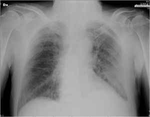 Chest-X-Ray at admission in emergency room showing left lung parenchymal consolidation and ipsilateral pleural effusion.