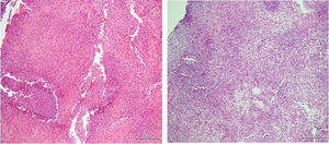 Histologic specimen shows a non-caseating granulomatous inflammation (left panel); the PAS-stain was positive (right panel) but the PCR detection for Tropheryma whipplei was negative.