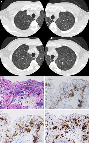 (A) Chest high-resolution computed tomography revealing diffuse ground glass opacities and nodules with centrilobular augmentation in the bilateral lungs. (B) Microphotographs of the transbronchial lung biopsy specimen. Atypical lymphocytes are seen in the intravascular space of capillary blood vessels. Immunochemical staining revealing that these cells were positive for CD20 (C), CD79α (D), and Ki-67 (E).