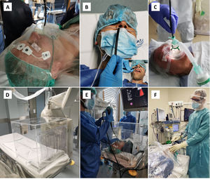 Strategies to minimize droplets dispersal during bronchoscopy. A. The bronchoscope may be introduced through an opening made at the oxygen mask, in this case with an additional plastic sheet covering the patient’s head. B. Transnasal approach, with oxygen supplementation through nasal cannula and a surgical mask placed over the patient’s mouth and the oral aspiration canulla. C. Bronchoscopy can be performed under ventilatory support, using a closed circuit ventilation and non-ventilated masks with a dedicated bronchoscope entrance. D. Transparent protective box may contain droplet particles inside. E. Protective box placed over the patient’s head during endobronchial ultrasound. F. Rigid bronchoscopy with rubber caps on the ports of the scope and a plastic covering.