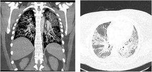 Chest CT scan on presentation showing bilateral infiltrates. Left: coronal view; right: axial view.