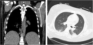 Chest CT scan follow up showing resolution of the bibasilar infiltrates. Left: coronal view; right: axial view.