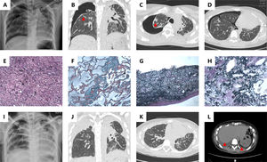 (A) Chest radiograph shows pneumothorax on the right side; High resolution computed tomography (HRCT) coronal (B) and axial (C) show pneumothorax on the right side, bilateral pleurae thickening and subpleural parenchymal consolidation (red arrow); (D) HRCT shows that the fibrosis and consolidation are scanty of the lower lobes. (E) Section of pleurae biopsy (H&E stain ×100) shows the thickened pleura; (F) Masson’s trichrome stain (×100) demonstrates dense fibrosis in subpleural lung parenchyma; (G) Elastic Van Gieson (EVG) stain (×100) highlights excessive elastin fibers deposition in pleura; (H) EVG stain (×100) reveals subpleural lung parenchyma. (I) Chest radiograph shows peumothorax on the left side; (J) HRCT coronal plane shows progressive bilateral pleurae thickening; (K) HRCT axial plane exhibits increasing linear and patchy opacities in the lower lobe; (L) HRCT exhibits bilateral pleural effusion (red arrow).