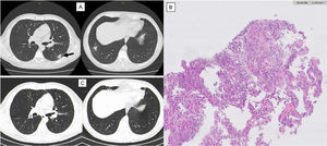 Imaging evolution and histology of Organizing Pneumonia secondary to Varicella-Zoster infection. Thoracic computed tomography (CT). A) One year after varicella-zoster infection showing a micronodular pattern with mostly calcified nodules. In the lower right lobe, a dense 19 mm nodule with ground-glass pattern and, juxtaposed to this, other two calcified nodules. Growth of the previously reported lesion in the lower-left lobe, measuring 21 mm (arrow). CT guided biopsy of the lower left lobe lesion. B) Anatomopathological exam showing focal lesions of organizing pneumonia with foamy macrophages in intralveolar localization. Thoracic CT. C) One year after corticosteroid treatment maintaining micronodular pattern with calcified nodules, but with complete resolution of the previously described lesions.
