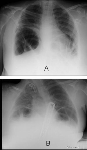 The radiograph of the chest and the upper abdomen of the two patients with Acute Colonic Pseudo-Obstruction (A=case 1; B=case 2).