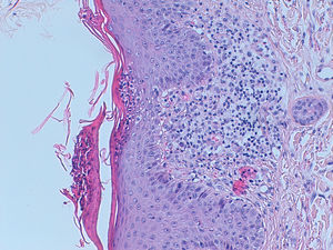 Skin biopsy. A lymphocytic infiltrate with some cells with big nuclei with irregular borders is seen at the superficial dermis. CD4+ and CD8+ cells are in an equilibrated number. Some CD8+ cells are positive for granzyme B. No eosinophils are seen. PAS coloration negative. Within an adequate clinic context, this biopsy is compatible with DRESS syndrome.