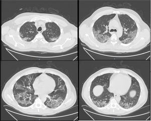CT-scan. Bilateral consolidations with ground-glass areas, mainly in the posterior dependent zones.