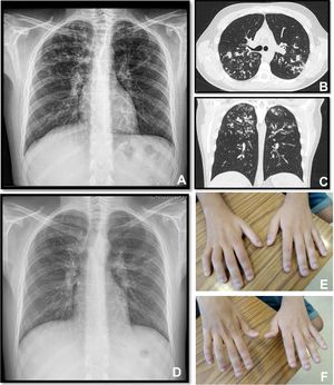 Panel A, B and C: Chest x-ray and thoracic computed tomography showed cylindrical bronchiectasis with wall thickening associated with a tree-in-bud micronodular pattern; Panel D: Chest x-ray with radiological improvement, after CF therapy was initiated; Panel E-F: severe weakness of upper limbs (worse in the upper right limb with muscle atrophy).