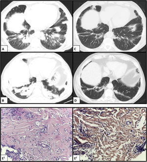 Chest CT scan showing bilateral peripheral consolidation areas in the lower lobes before (A and B) and after (C and D) complete chemotherapy scheme. (E1) Histology showing hyalinized lamellar collagen tissue surrounded by lymphoplasmacytic infiltrates (hematoxylin and eosin, ×200); and (E2) negative Congo red stain (CR, ×200).