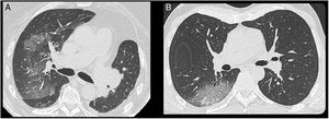 CT scan of a 74-year-old woman showing unilateral ground-glass opacities in the right upper lobe (A), and a 47-year-old man showing unilateral crazy paving in the right lower lobe (B). Both patients had initially tested negative by NP/OP swab.