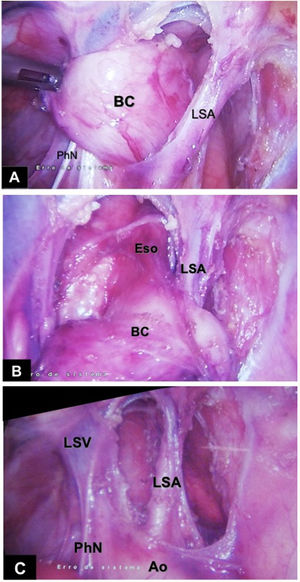 (A–C): Intraoperative view. Ao—aortic arch; BC—bronchogenic cyst; Eso—esophagus; LSA—left subclavian artery; LSV—left subclavian vein; PhN—phrenic nerve.