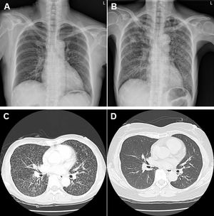 Clinical images of miliary TB in a RA patient receiving TNF mAb therapy. (A). A clear chest X-ray without any lung lesions before starting TNF mAb therapy. (B). Bilateral diffuse military lesions on chest X-ray after TNF mAb therapy. (C). Bilateral innumerable micronodular opacities on chest computed tomography after TNF mAb therapy. (D). Resolved bilateral military nodules on chest computed tomography after anti-TB treatment.