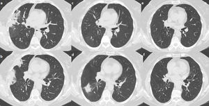 Areas of consolidation in the right upper and middle lobe. The consolidative area in the right middle lobe has a “bird nest” appearance (panel a, b). After 4 months under steroid treatment there is clearance of the infiltrates in the right upper and middle lobe. There is a new area of consolidation in the right lower lobe consistent with a migratory pattern (panel c, d). After 6 months under steroid treatment there is a complete resolution of the imaging findings (panel e, f).