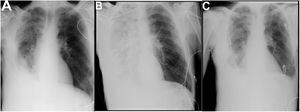 Imaging evolution during ICU stay. A) Reduction of pleural effusion after placement of chest tube. B) Apicocaudal opacification at the right pulmonary field, compatible with reexpansion pulmonary edema. C) Improvement of right lung field opacification at discharge from the ICU.