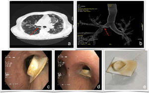 Image a. Visualization of the foreign body in thoracic CT (indicated by the arrow). Image b. Reconstruction of the bronchial tree with foreign body at the level of the right main bronchus (indicated by the arrow). Image c. Impacted foreign body in the right main bronchus with image from the main carina. Image d. Visualization of foreign body impacted at the entrance of the right main bronchus. Image e. Foreign body once removed by biopsy forceps.
