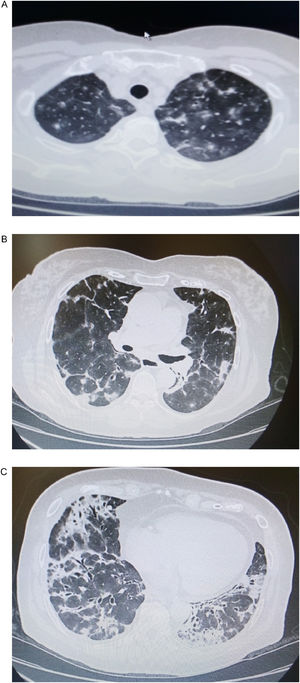 (a, b) Chest CT showing bilateral multiple consolidations with distribution accompanied by ground glass opacities throughout the upper and middle lung fields. (c) Bilateral consolidations with peribronchovascular distribution and dilated airways within them are visible in the lower lung fields.