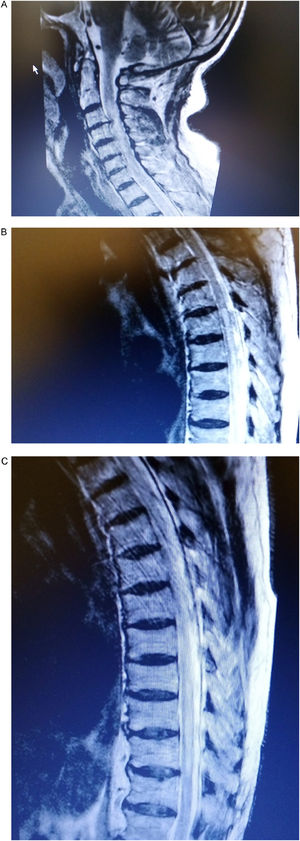 (a–c) Cervical and thoracic spine MRI demonstrating high intensity signals at the C1–2, C4–7 levels and T6–9 on T2-weighted imaging.