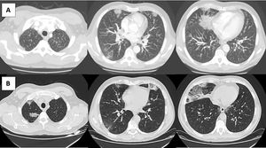 Imaging evolution of the patient. A) Computed tomography (CT) pulmonary angiography with consolidations and ground-glass opacities predominantly peripheral. B) CT scan of the thorax taken one week later, showing migratory bilateral consolidations that were predominantly peripheral and an increase in crazy paving areas and ground-glass opacities.